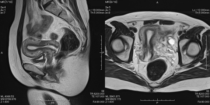 骨盤内MRI画像