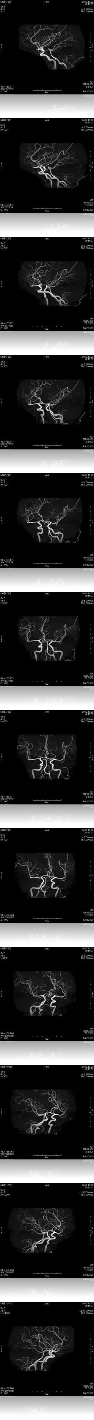 MRA画像